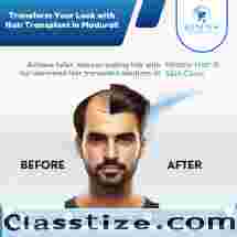 hair transplant in madurai - Renew Hair and Skin Care