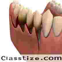 Best Periodontal surgery treatment in Dubai UAE