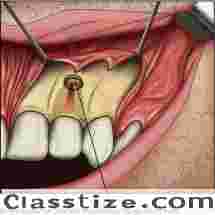 Best Endodontic surgery clinic in Dubai UAE