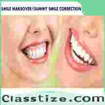 Best Smile Makeover treatment in Dubai UAE