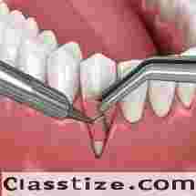 Best Gum Grafting clinic in Dubai UAE