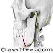 Best Jaw Fractures clinic in Dubai UAE