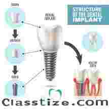 Best Dental Implants Treatment in Sarjapur Road, Bangalore