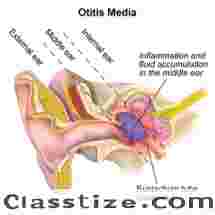 Chronic Suppurative Otitis Media Symptoms