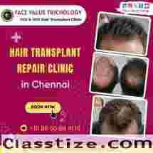 Best Hair Transplant Clinic in Chennai