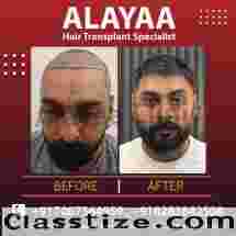 Steps to Prepare for a Best Hair Transplant Clinic in Chandigarh