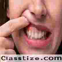 Best Gum care treatment in Dubai UAE