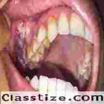 Best oral cancer treatment clinic in Dubai UAE