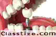 Best Dental Implant Clinic in Kolkata