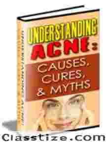 Understanding Acne : Causes, Cures & myths