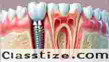 Best Dental Implant Clinic in Nagerbazar